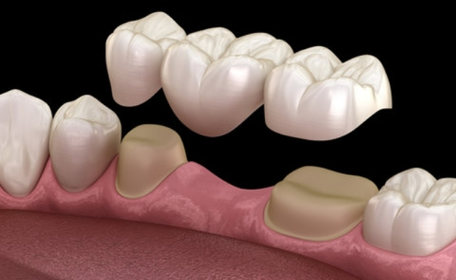 Dental Bridges-------30