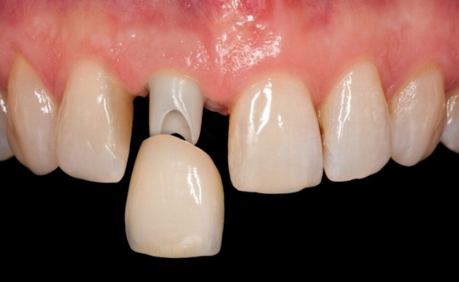 Dental Crowns------30