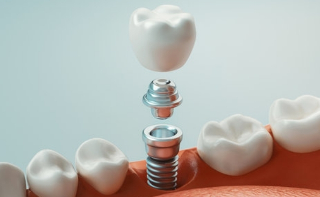 Dental implants-----32