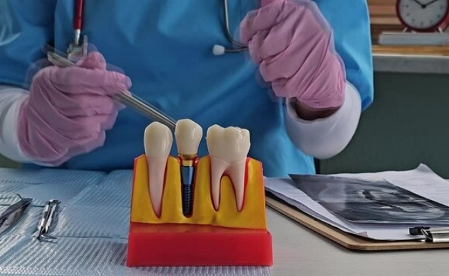 Root Canal Treatment
